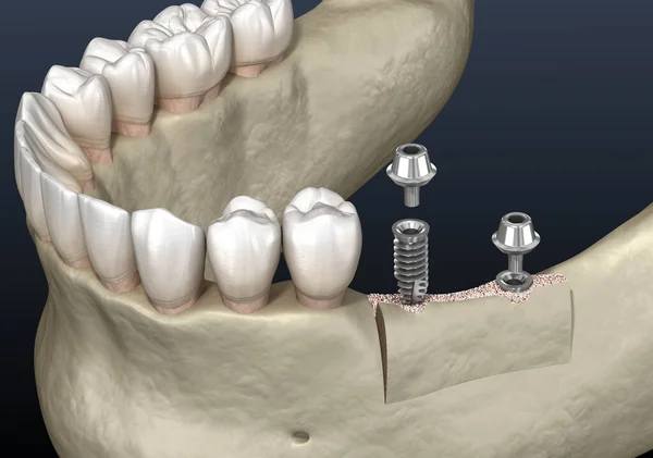 Scollatura Della Cresta Alveolare Impianto Chirurgia Dentale Illustrazione — Foto Stock