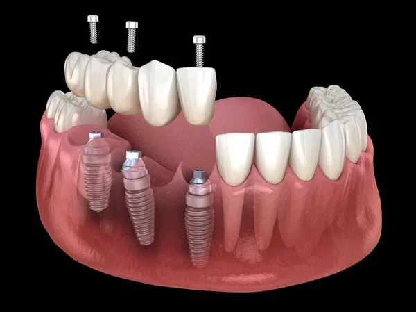 Dental bridge based on 3 implants. Medically accurate 3D illustration of human teeth and dentures concept
