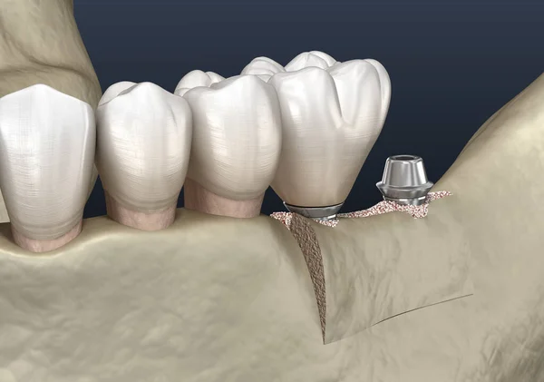 Alveolar Sırt Dekoltesi Implantasyon Diş Cerrahisi Boyutlu Illüstrasyon — Stok fotoğraf