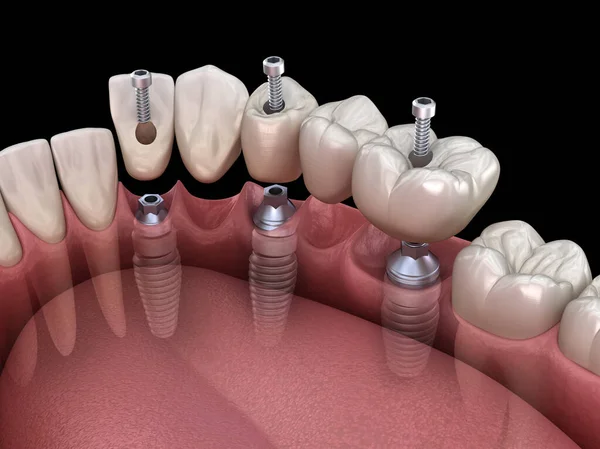 インプラント3本による歯科用ブリッジ 人間の歯と入れ歯の概念の医学的に正確な3Dイラスト — ストック写真