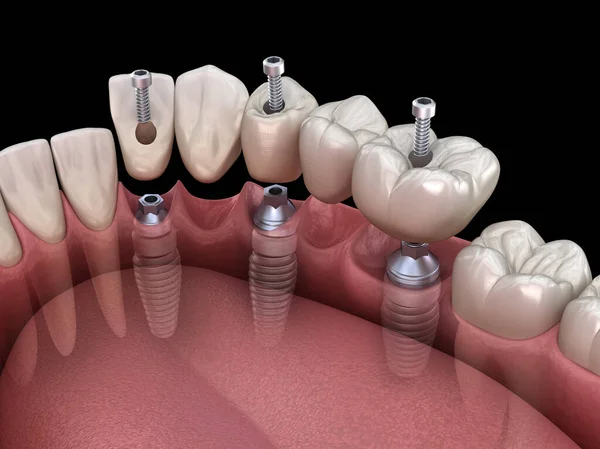 Puente Dental Basado Implantes Ilustración Médicamente Precisa Del Concepto Dientes — Foto de Stock