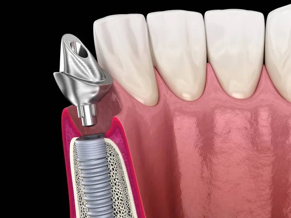 Okolica Implantu Implant Stomatologiczny Ceramiczna Korona Medycznie Dokładna Ilustracja Zęba — Zdjęcie stockowe