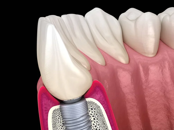 Стандартный Имплантат Зубной Имплантат Керамическая Коронка Медицинская Точность Трехмерной Иллюстрации — стоковое фото