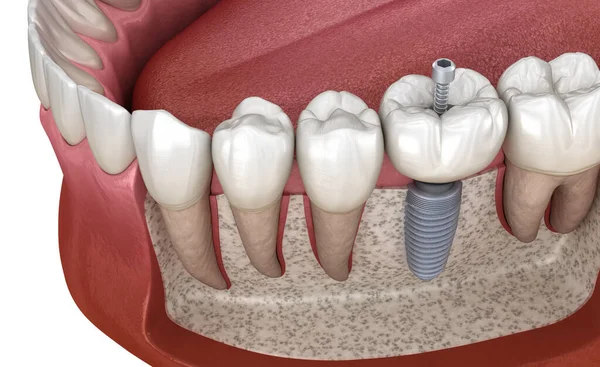 Molar Tooth Crown Installation Implant Abutment Medically Accurate Illustration Human — Foto de Stock