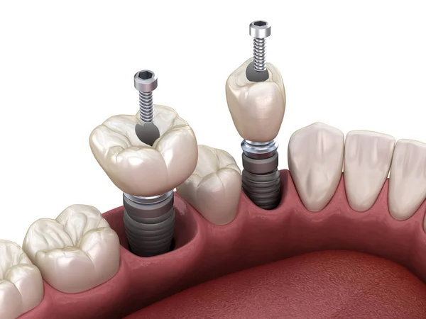Премолярна Молярна Коронка Зуба Над Імплантатом Фіксація Гвинта Ілюстрація Стоматологічного — стокове фото