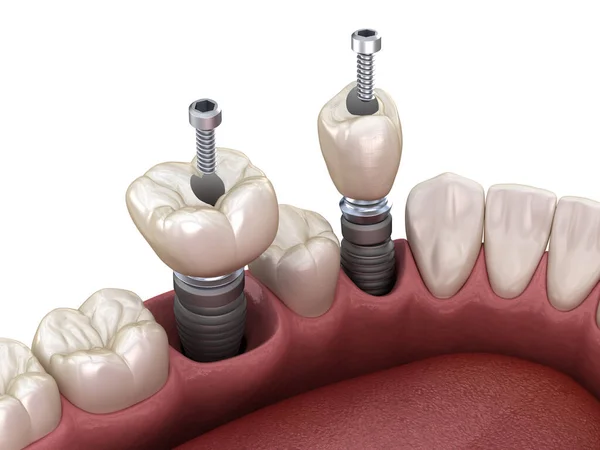 Installazione Corona Denti Premolari Molari Impianto Fissaggio Vite Illustrazione Del — Foto Stock