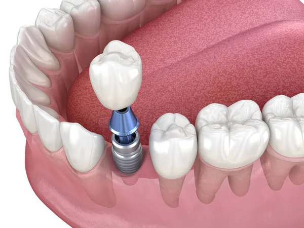 Преждевременное Восстановление Зубов Имплантатом Медицинская Точность Иллюстрации Концепции Человеческих Зубов — стоковое фото