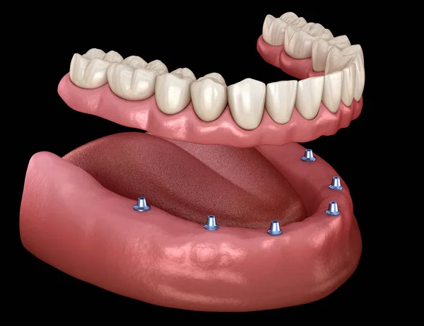 Mandibulaire Prothese Met Tandvlees Alles Systeem Ondersteund Door Implantaten Medisch — Stockfoto