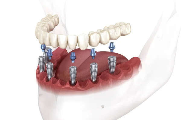 Prótese Mandibular Todos Sistema Suportado Por Implantes Ilustração Medicamente Precisa — Fotografia de Stock