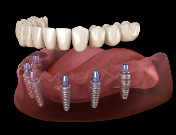 Proteza Żuchwy Wszystko Systemie Wspomaganym Przez Implanty Medycznie Dokładna Ilustracja — Zdjęcie stockowe