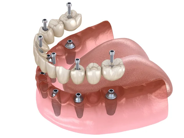 下颌骨假体与牙龈全部在6个系统支持植入物 医学上准确的人类牙齿和假牙概念三维图像 — 图库照片