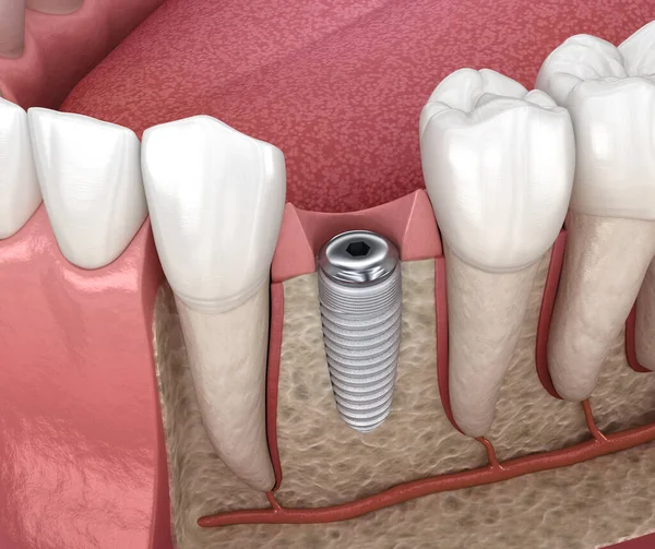 Instalación Corona Dental Molar Sobre Implante Titanio Ilustración Médicamente Precisa — Foto de Stock