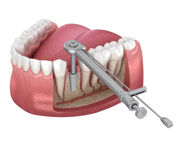 Zubní Momentový Klíč Fixuje Implantát Kost Lékařsky Přesná Zubní Ilustrace — Stock fotografie