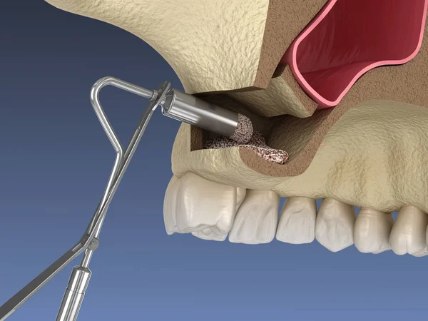 Chirurgie Sinus Lift Ajout Nouvel Artificiel Illustration — Photo