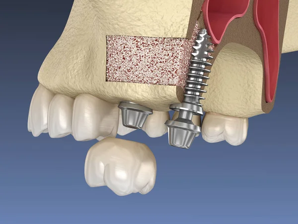 Sinus Lift Surgery Implant Installation Illustration — Stock Photo, Image