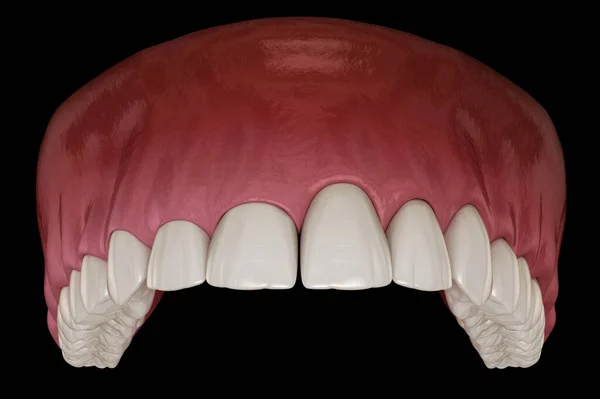 Gingivectomy surgery with laser using.  Medically accurate tooth 3D illustration