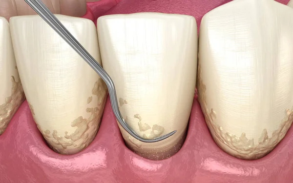 Oral hygiene: Scaling and root planing (conventional periodontal therapy). Medically accurate 3D illustration of human teeth treatment