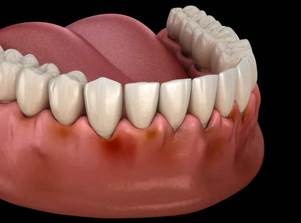 Gingivitis Entzündung Des Zahnfleisches Medizinisch Korrekte Darstellung — Stockfoto