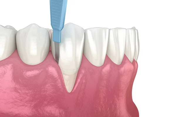 Kauwgom Recessie Weke Delen Transplantatie Chirurgie Illustratie Van Tandheelkundige Behandeling — Stockfoto