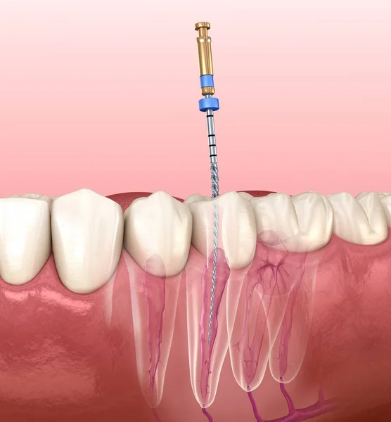 Endodontický Kořenový Kanálový Léčebný Proces Lékařsky Přesná Zubní Ilustrace — Stock fotografie