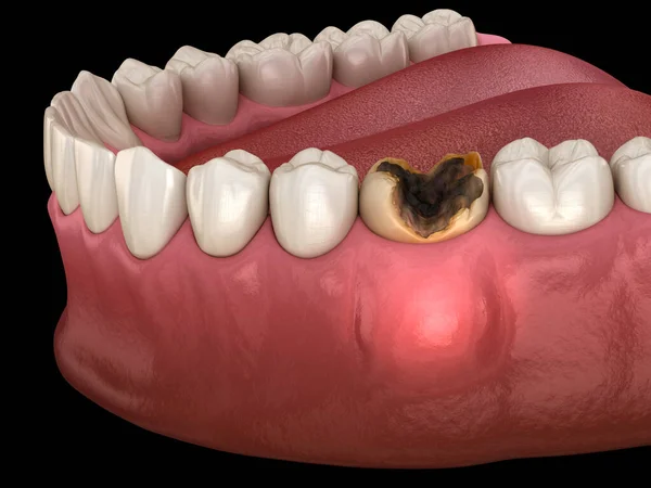 歯周炎歯 歯の上のガムに塊 医学的に正確な歯科3Dイラスト — ストック写真