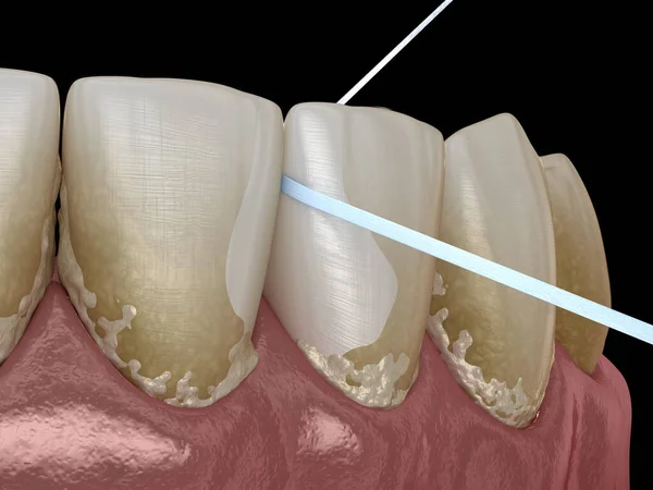 Mondhygiëne Met Behulp Van Tand Floss Voor Het Verwijderen Van — Stockfoto