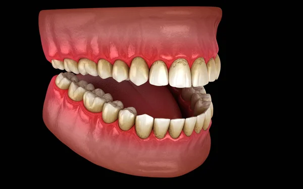 タルタルとバックトレイル歯の歯垢 顎の炎症 人間の歯の治療の医学的に正確な3Dイラスト — ストック写真