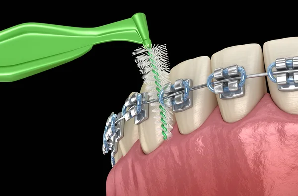 Чистка Межзубной Щетки Брекетов Медицинская Точность Иллюстрации Гигиены Полости Рта — стоковое фото
