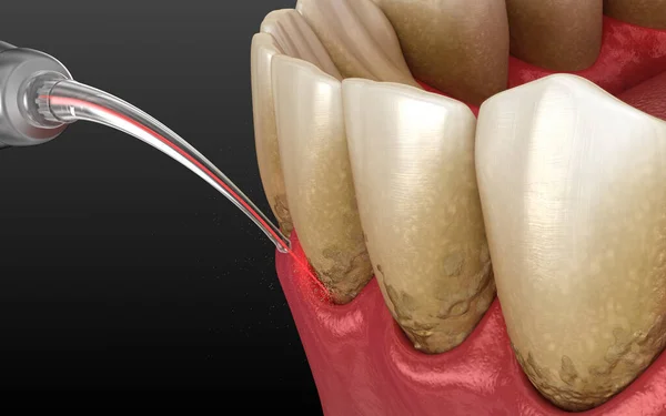 Laser Odstraňuje Zubní Kámen Tenkou Vrstvu Infikované Kůže Čištění Zubů — Stock fotografie