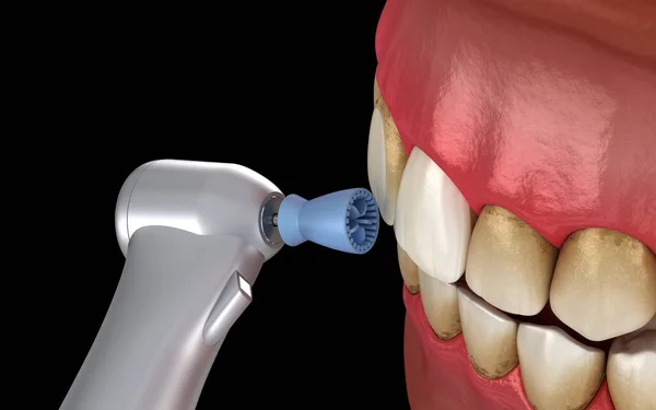 Процедура Полировки Зубов Профессиональной Щеткой Гелем Медицинская Точность Иллюстрации — стоковое фото