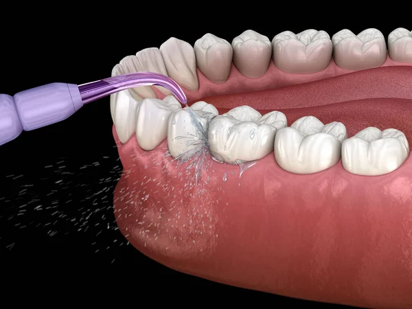 Toothbrush cleaning teeth. Medically accurate 3D illustration of oral hygiene.