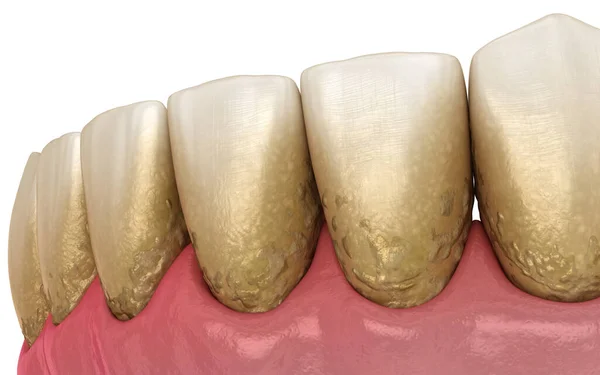 Tandplak Met Tandsteen Bactrail Onderkaak Medisch Nauwkeurige Illustratie Van Behandeling — Stockfoto