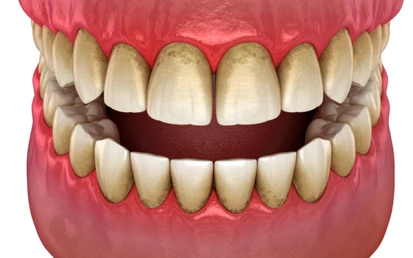 Tartar Bactrail Tooth Plaque Jaw Inflammation Medically Accurate Illustration Human — Stock Photo, Image