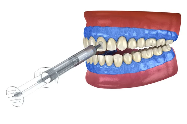 プロの歯が白くなる 歯にゲルを追加します 3Dイラストのコンセプト — ストック写真