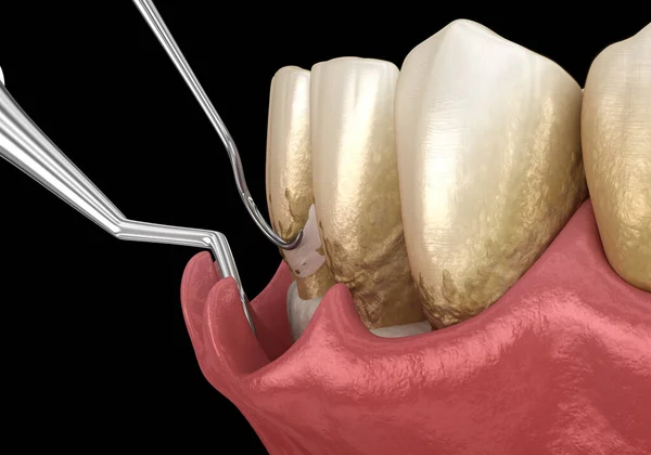 鳞片和根部修整 传统的牙周病治疗 医学上准确的人类牙齿治疗三维图像 图库图片