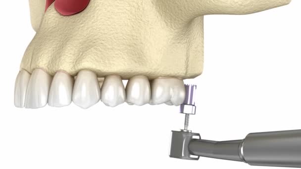 Sinus Lift Surgery Фронтальним Доступом Анімація Стоматологічної Хірургії — стокове відео