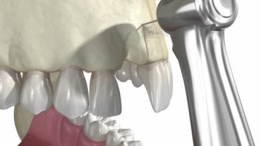 Kemik nakli, kemik bloğu kullanılarak büyütülmüş, diş nakli. Tıbbi olarak doğru 3B canlandırma.