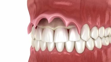 Ön taç uzatma, estetik ameliyat. Tıbben doğru 3 boyutlu diş canlandırması