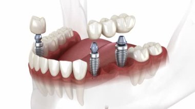 Dental bridge and crown placement over implants. Dental 3D animation concept