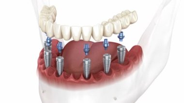 Çıkarılabilir çene protezi. Hepsi de implantlar tarafından desteklenen 6 sistemde. İnsan dişlerinin ve protezlerinin tıbbi açıdan doğru üç boyutlu animasyonu
