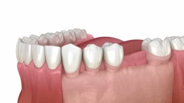 Diş implantı kurulumu, özel apati ve seramik kaplama. Tıbbi olarak doğru diş 3D animasyonu.