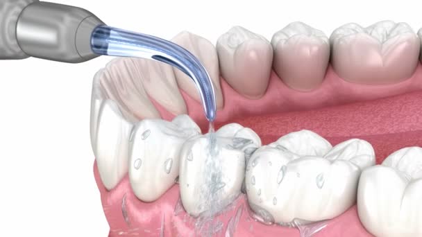 Irrigateur Nettoyage Des Dents Eau Animation Médicalement Précise Hygiène Buccodentaire — Video