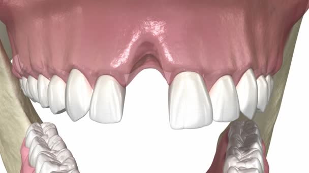 Injerto Óseo Aumento Con Hueso Membrana Artificiales Implantación Dental Animación — Vídeo de stock