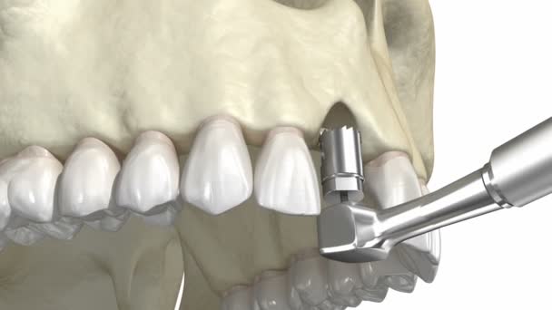 Innesto Osseo Aumento Con Metodo Anello Impianto Dentale Animazione Clinicamente — Video Stock