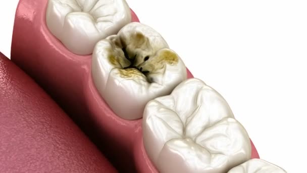 Restauración Corona Cerámica Onlay Dental Ilustración Médicamente Precisa Del Tratamiento — Vídeo de stock