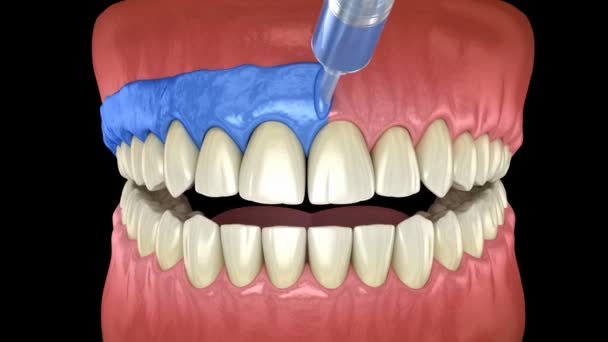 専門的な歯のホワイトニング 歯の漂白に光活性化 3Dアニメーションのコンセプト — ストック動画