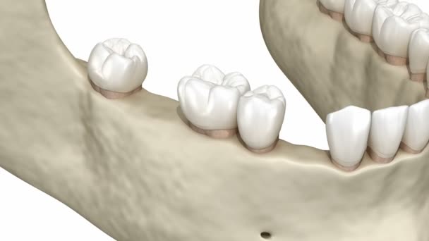 Zähne Verlagern Deformationen Nachdem Sie Zähne Verloren Haben Animation Des — Stockvideo