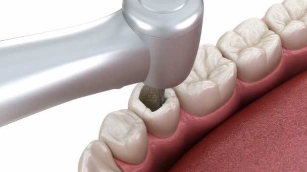 Premolární Zub Restaurování Kompozitní Výplní Lékařsky Přesná Zubní Animace — Stock video