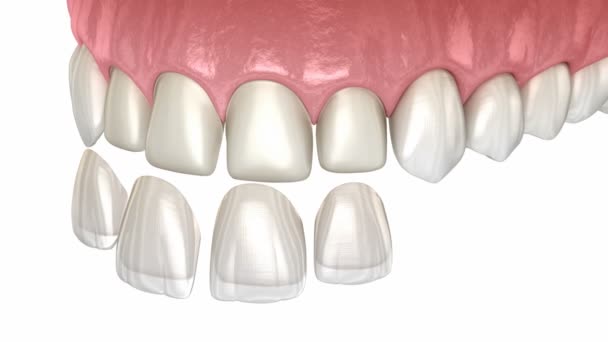牙齿上放置牙齿毒液 医学上准确的牙齿3D动画 — 图库视频影像
