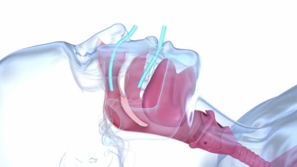Sleep Apnea Syndrome Labeled Nasal Tongue Blocked Airway Animation — 图库视频影像